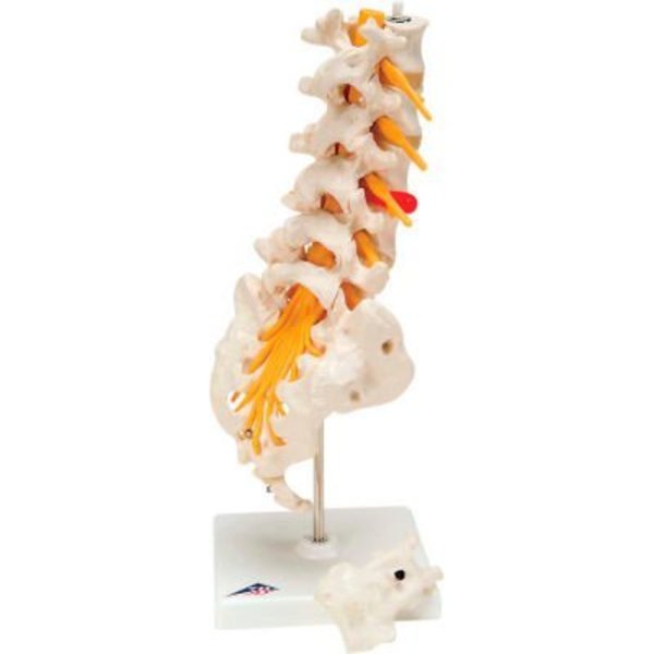 Fabrication Enterprises 3B® Anatomical Model - Lumbar Spinal Column with Dorso-Lateral Prolapsed Disc 965672